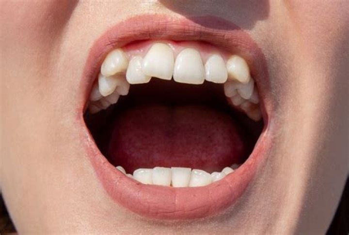 Are big teeth considered attractive?