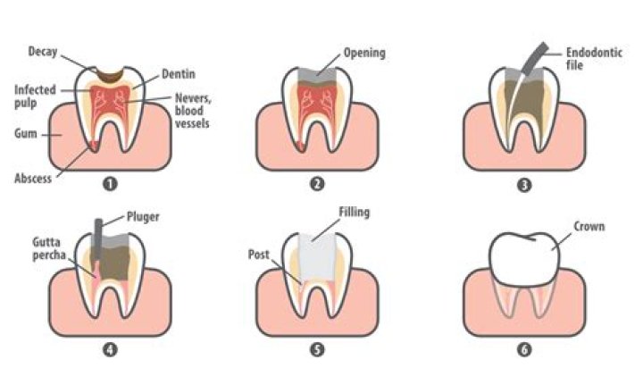 Are cavities permanent?