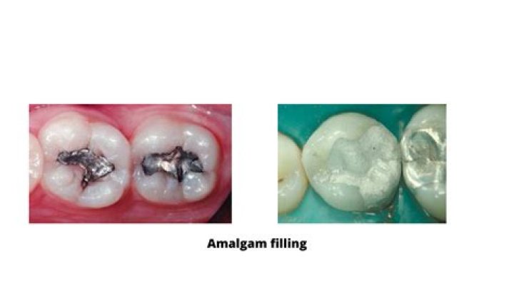 Are gold fillings better?