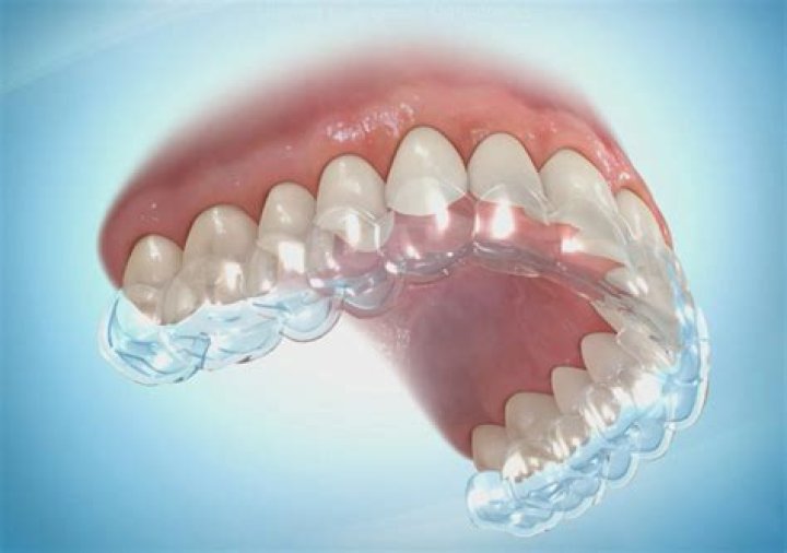 Are metal or clear retainers better?