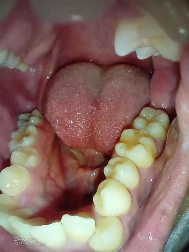 Are my teeth decaying?
