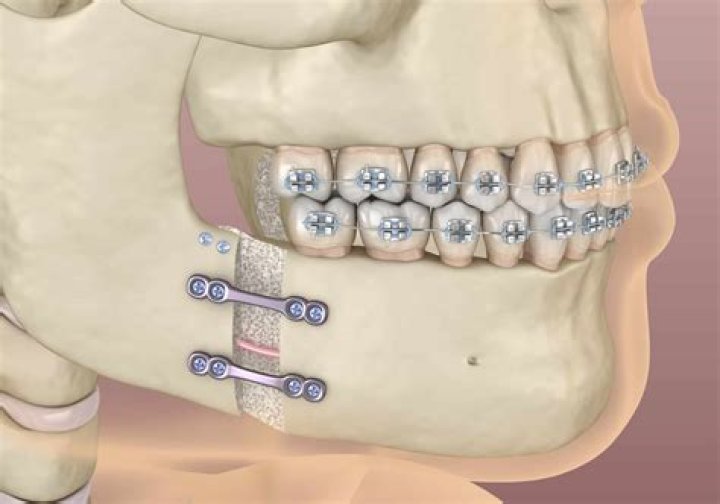 Are screws removed after jaw surgery?