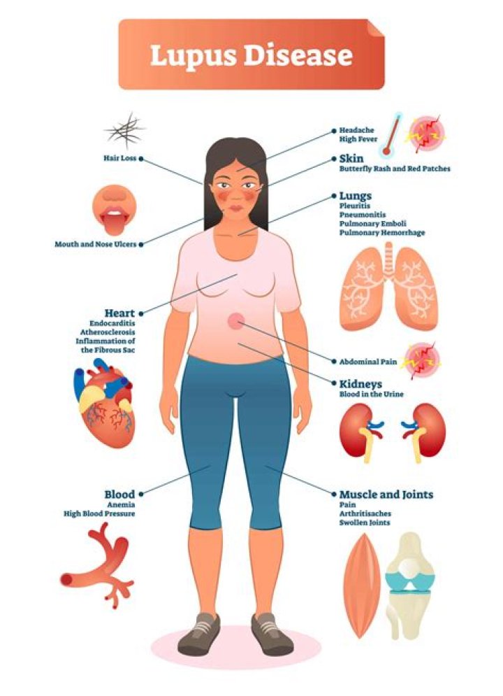 At what age is lupus usually diagnosed?
