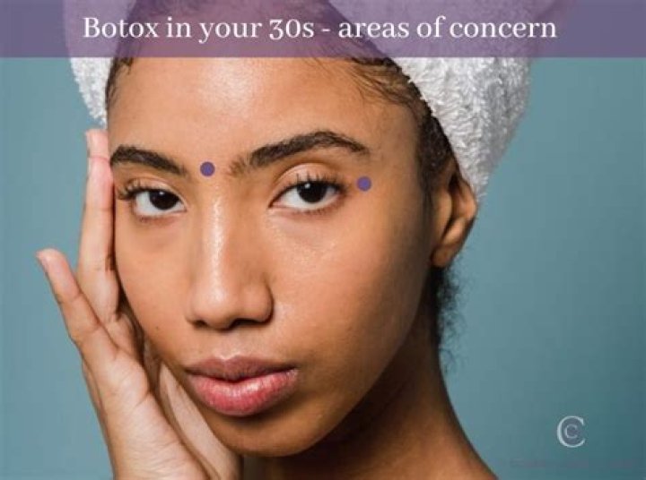 At what age should you get Botox?