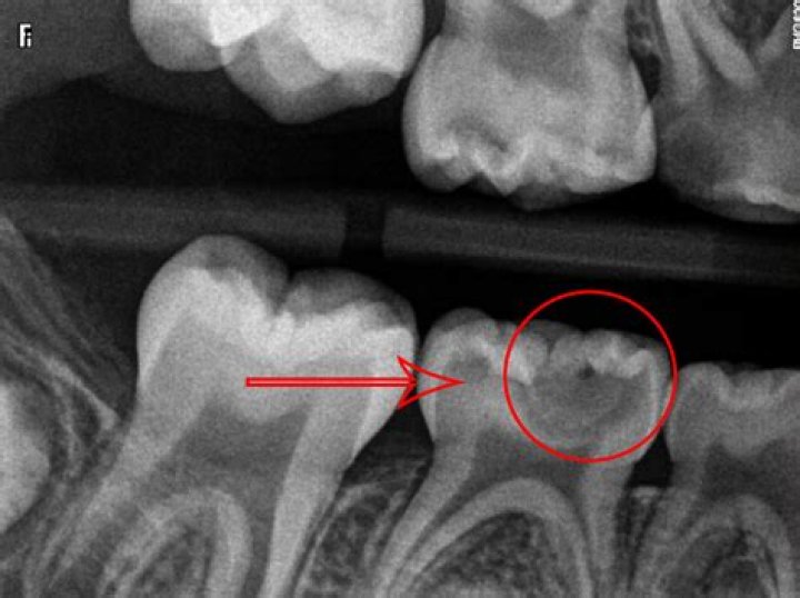 At what point do you get a tooth pulled?