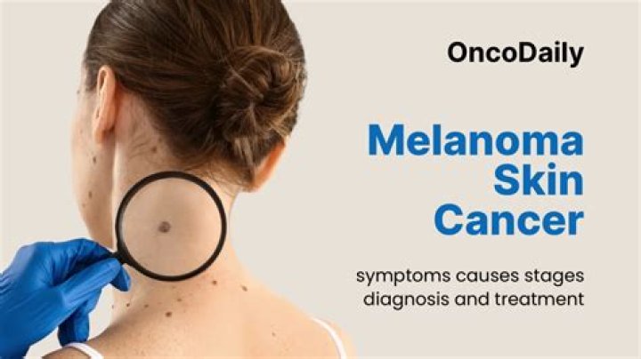 At what stage is melanoma usually diagnosed?