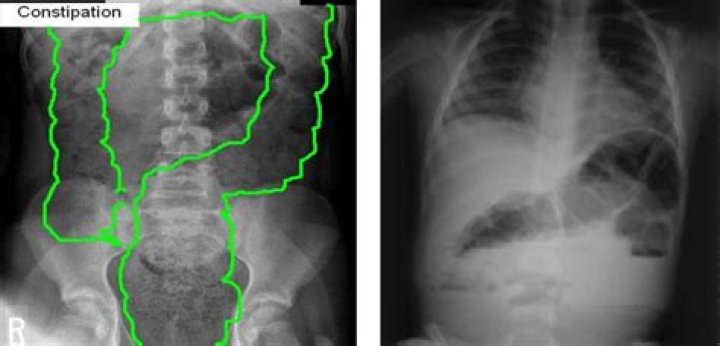 Can a baby pass gas if constipated?