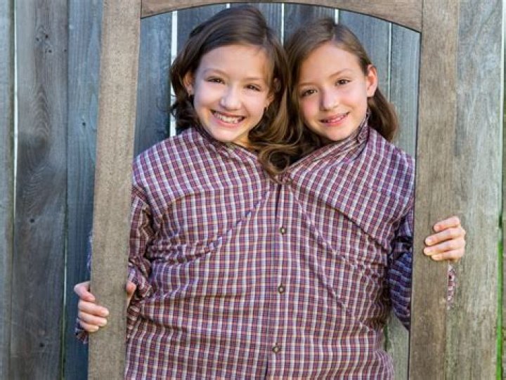 Can a boy and girl be conjoined twins?