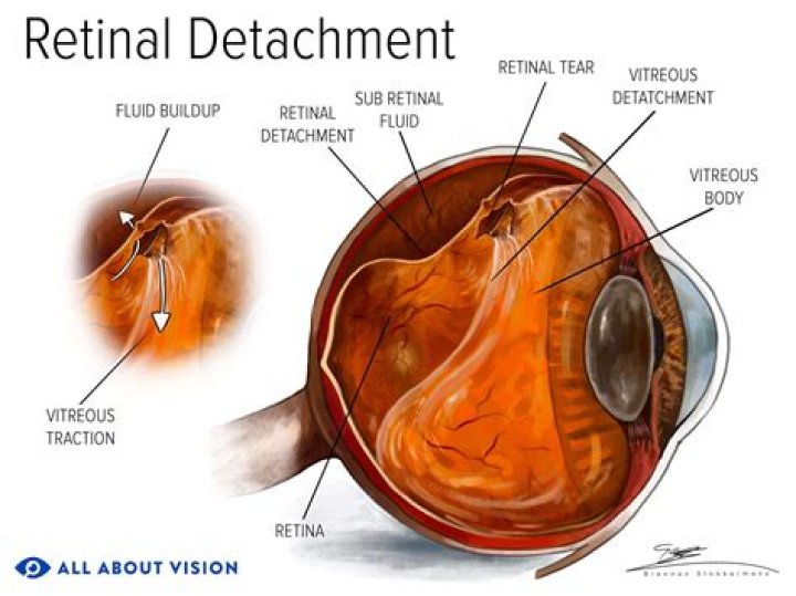 Can a detached retina be fixed without surgery?
