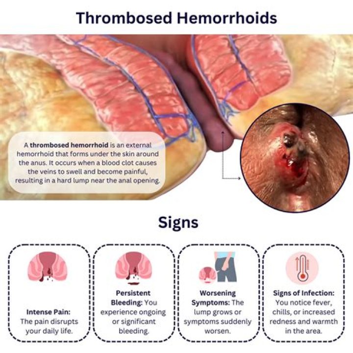 Can a hemorrhoid turn into a fissure?