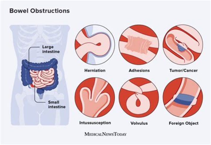 Can a hernia cause a bowel obstruction?