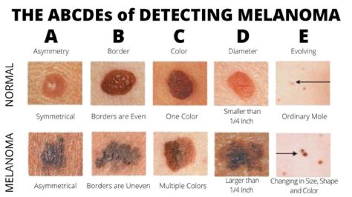 Can a new mole be melanoma?