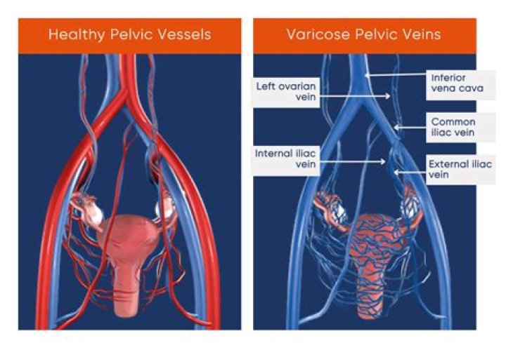 Can a pelvic mass be a fibroid?