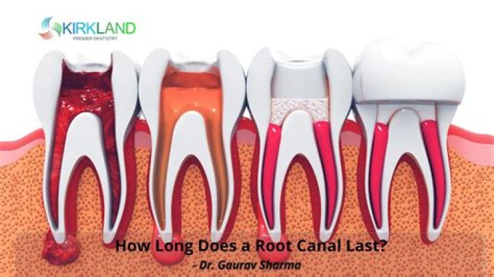 Can a root canal last a lifetime?