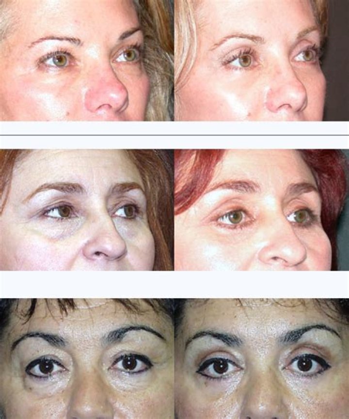 Can blepharoplasty be done twice?