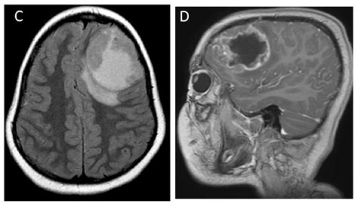 Can brain tumors be seen on MRI without contrast?