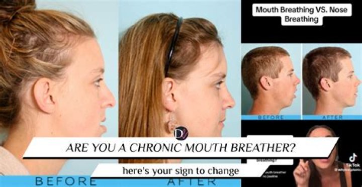 Can breathing through mouth cause facial deformities?