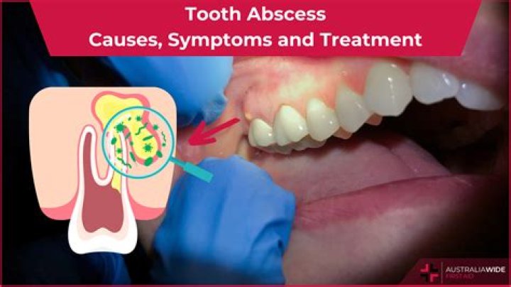 Can cephalexin treat an abscess tooth?