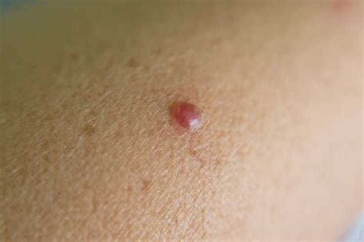 Can cherry angiomas become cancerous?