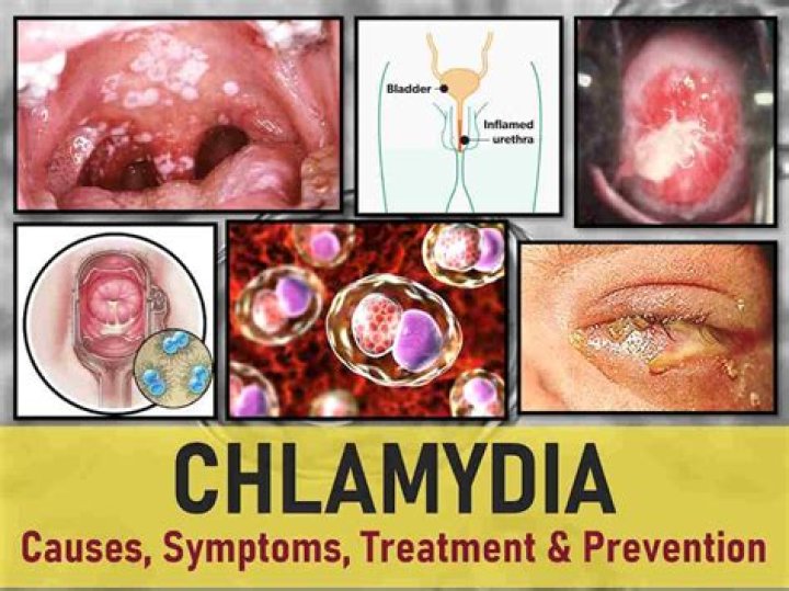 Can chlamydia come back after 5 years?