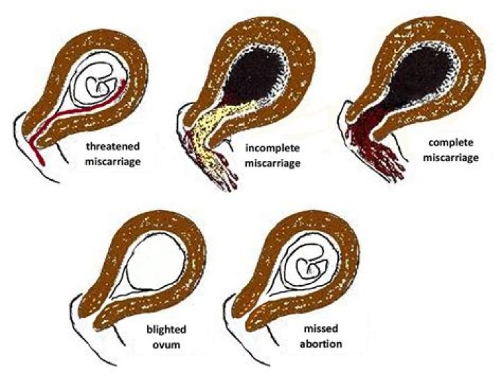 Can clove cause miscarriage in early pregnancy?