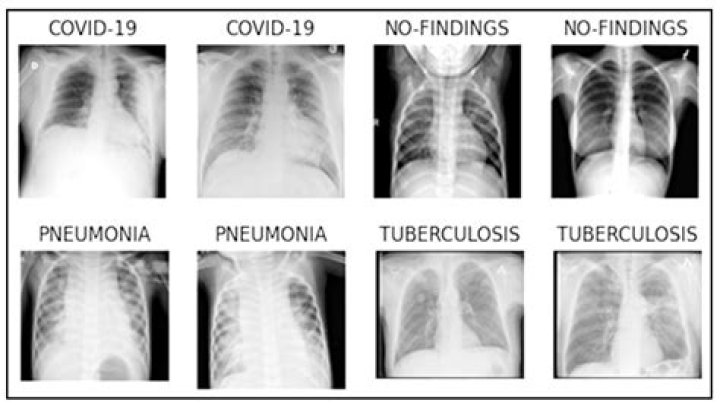Can COVID-19 be diagnosed by a chest X-ray?