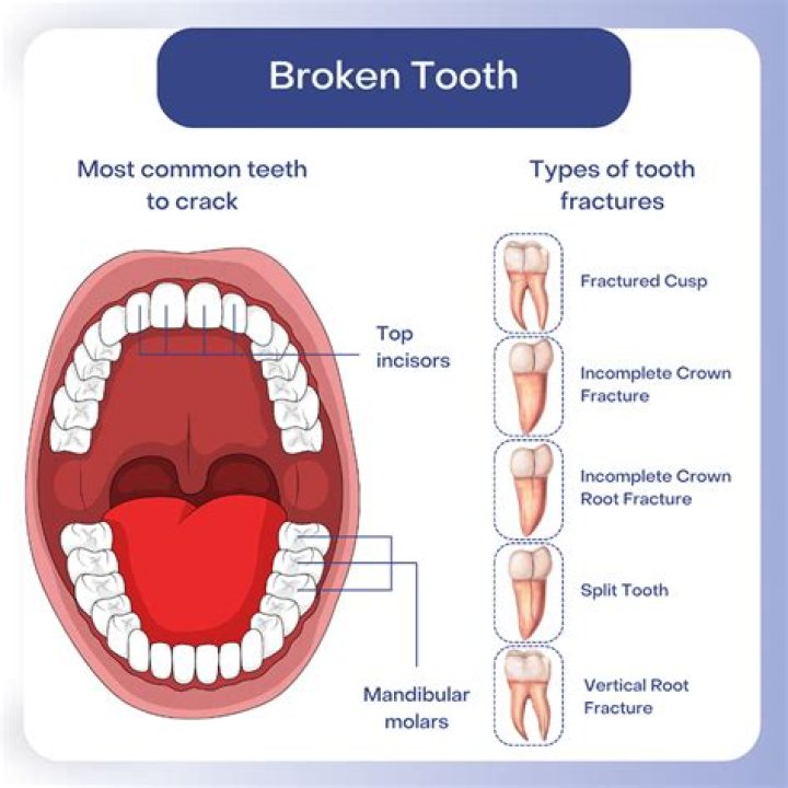 Can cracked teeth heal?
