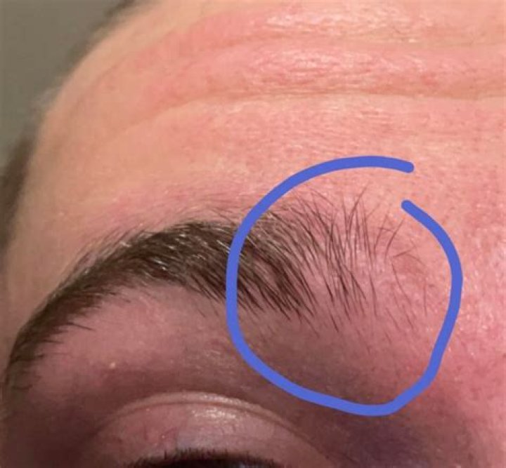 Can damaged eyebrow follicles be repaired?