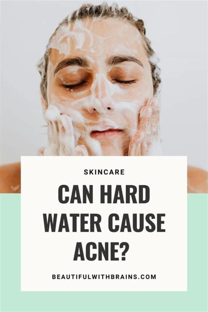 Can drinking water cause acne?