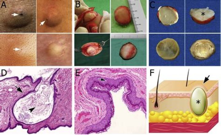 Can epidermoid cysts be cancerous?