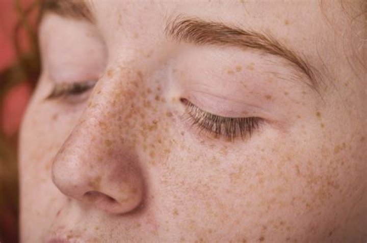Can eye freckles be removed?