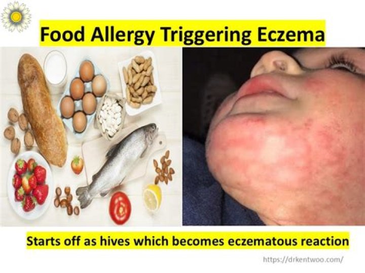 Can food allergies cause eczema?