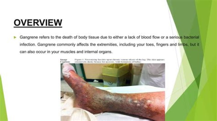 Can gangrene be cured?
