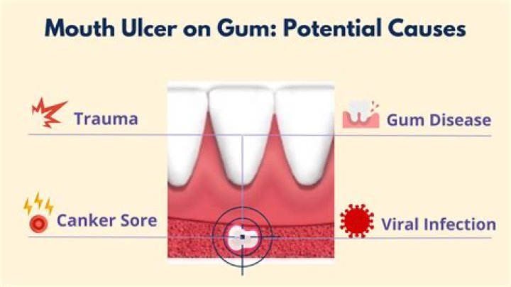 Can gum cause vomiting?
