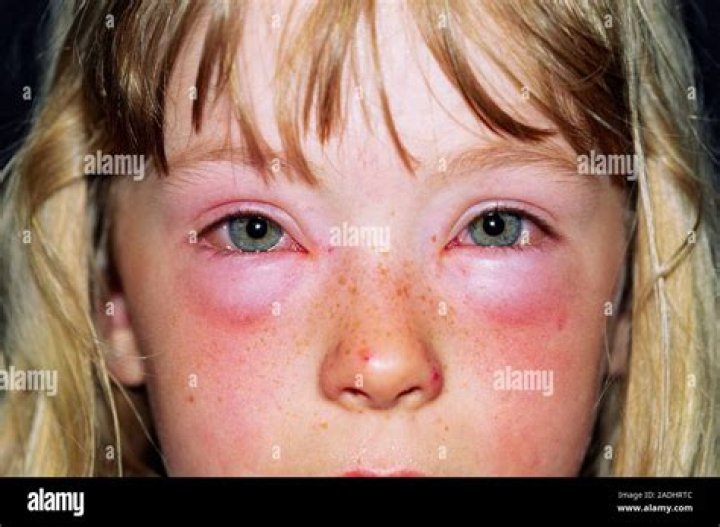 Can I be allergic to my tears?
