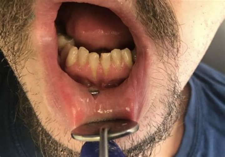 Can I brush my teeth with a tongue piercing?