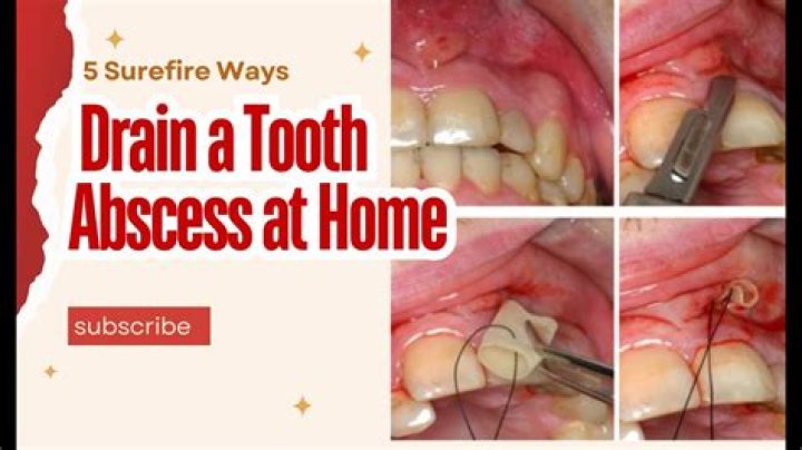 Can I drain a dental abscess myself?