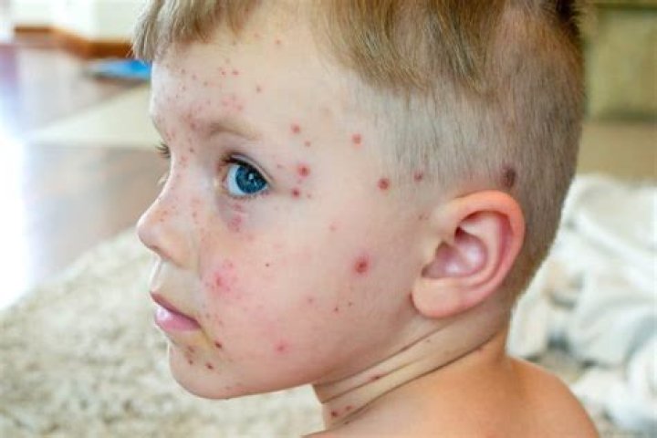 Can I get shingles if I didn't have chicken pox?