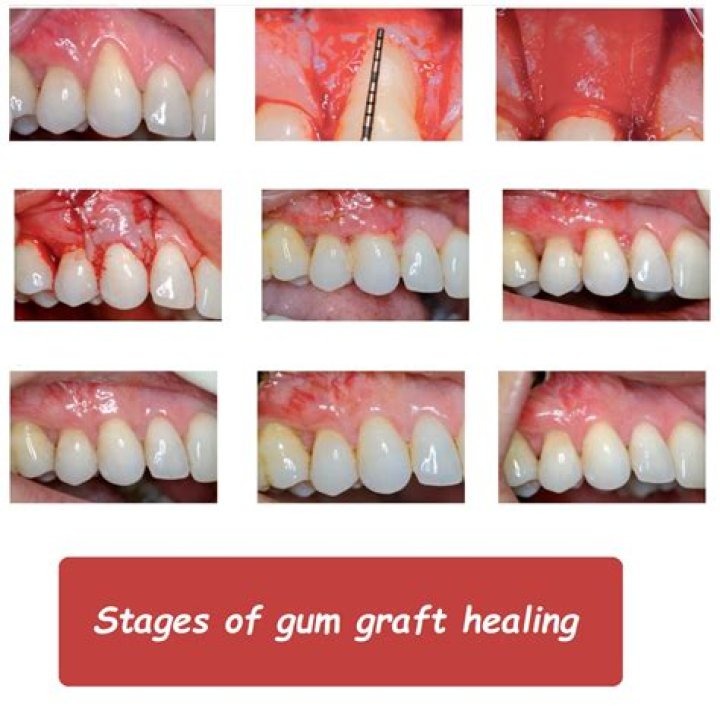 Can I go back to work after gum graft?