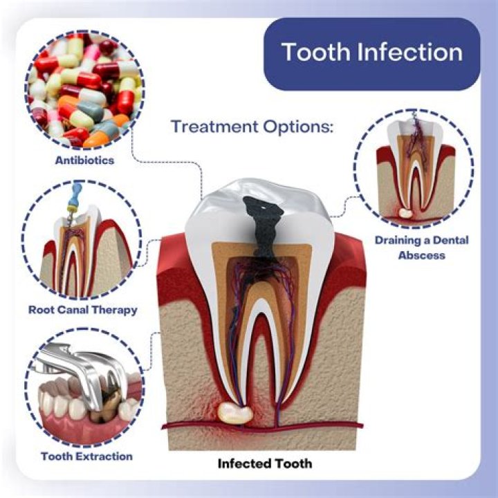 Can I have a tooth infection without pain?