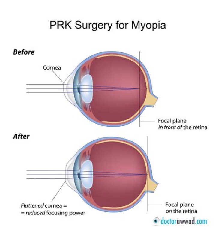 Can I look at my phone after PRK surgery?