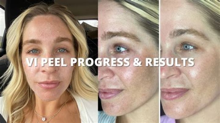 Can I peel beets in advance?