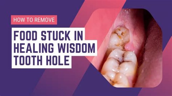 Can I remove my wisdom tooth at home?