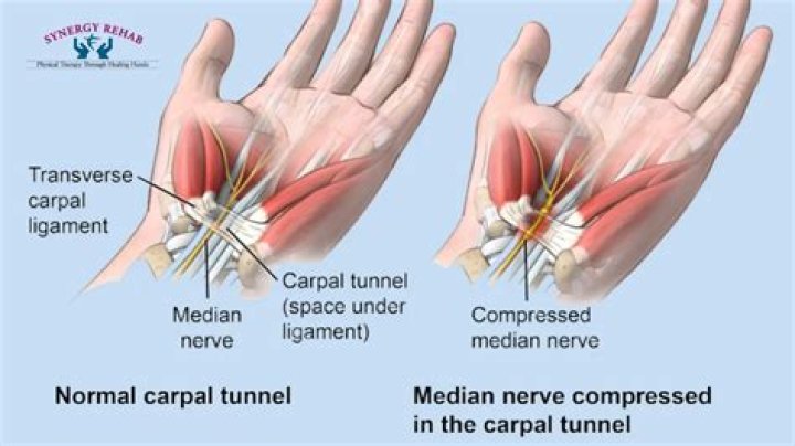 Can I reverse carpal tunnel without surgery?
