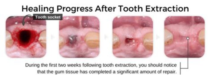 Can I touch my extraction site with my tongue?