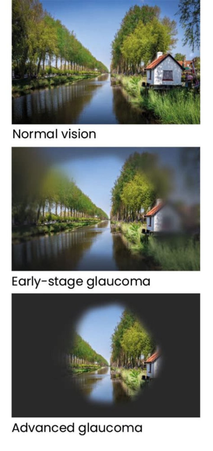 Can I use Visine if I have glaucoma?