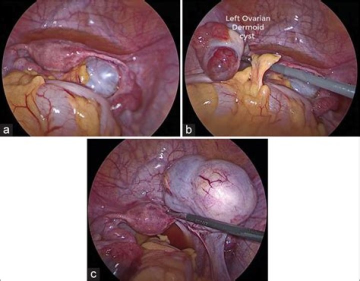 Can laparoscopy damage ovaries?