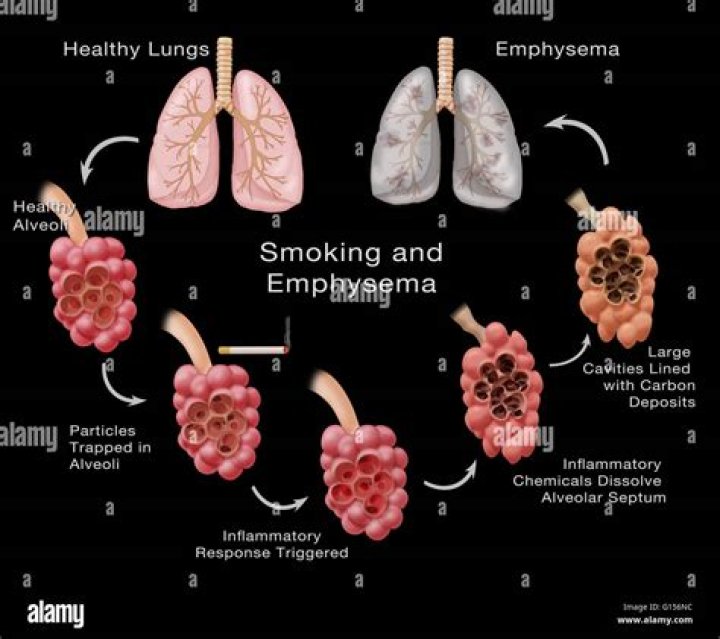 Can lungs recover from smoking?