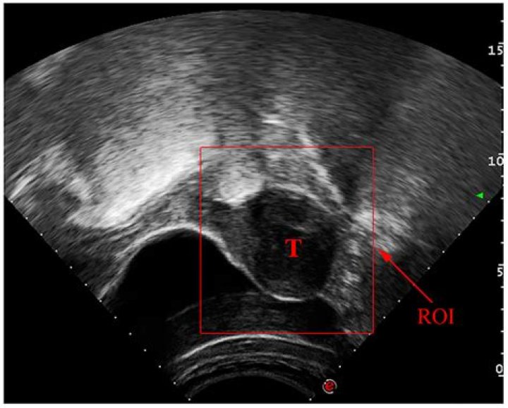 Can lymphoma be missed on ultrasound?