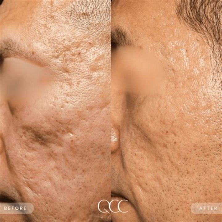Can microneedling make scars worse?